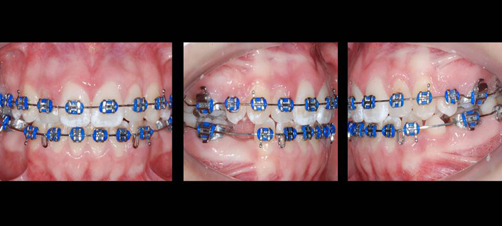 Tratamento: pré-molar transplantado restaurado e movimentado, 12 meses após o transplante