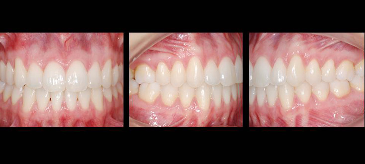 Caso final: oclusão normal com clareamento dental