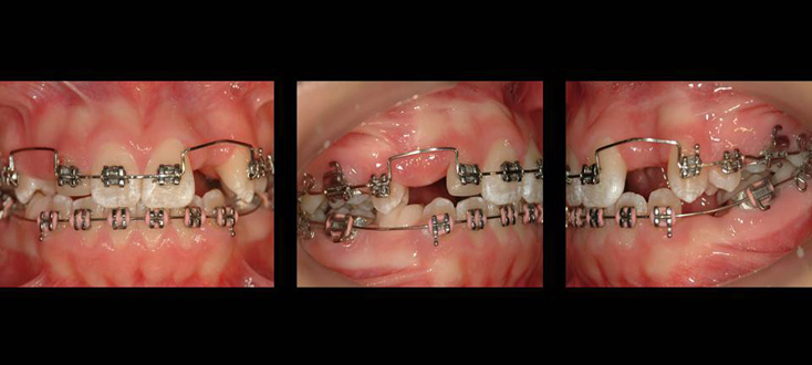 Tratamento: abertura de espaços para transplante