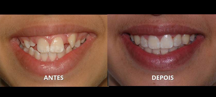Ausência dentária tratada com autotransplante