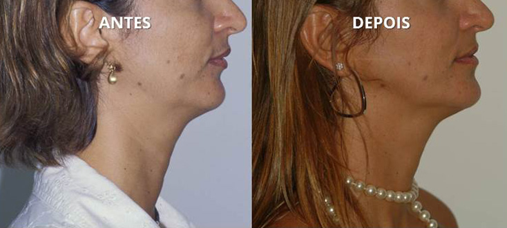 Correção com cirurgia combinada