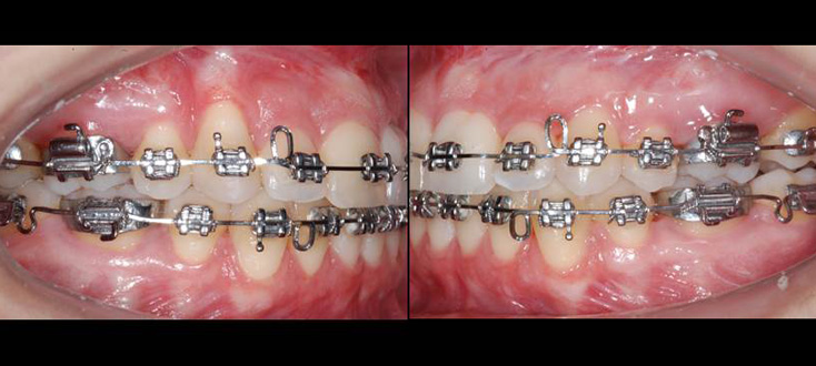 Depois da cirurgia