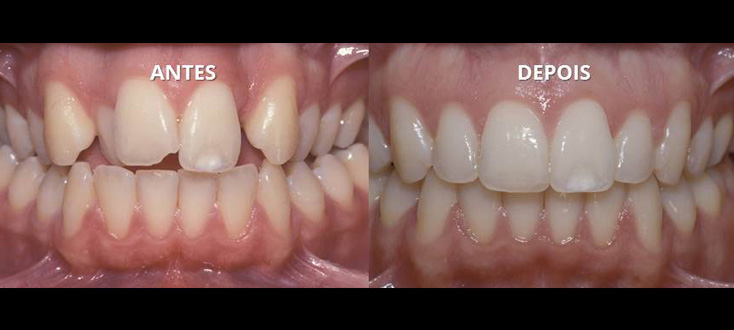 Problema esquelético tratado com compensações dentárias