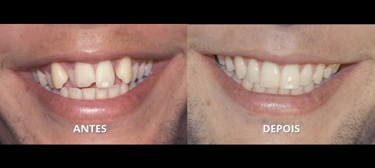 Problema esquelético tratado com compensações dentárias
