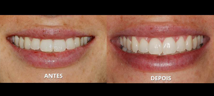 Desgastes interdentais para biprotusão dentária