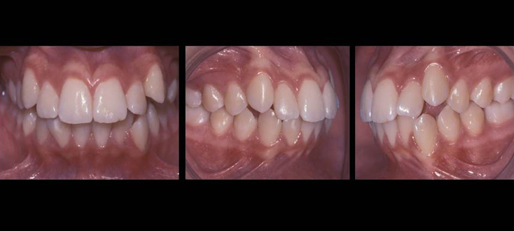 Caso inicial: dentes projetados e apinhados