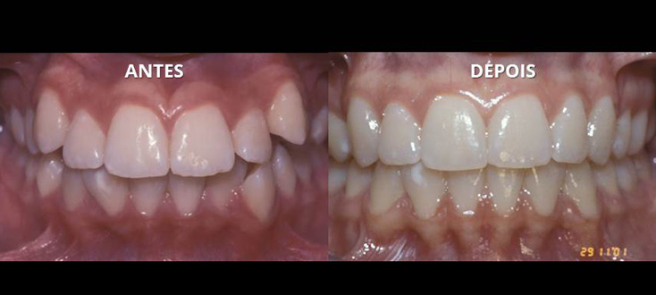 Tratamento com extrações dentárias