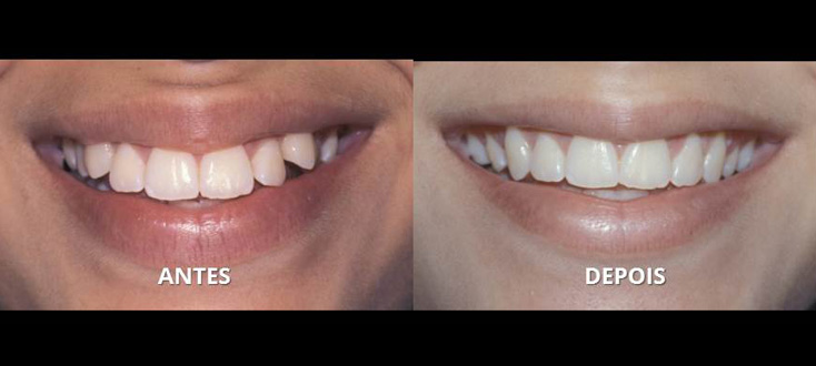 Tratamento com extrações dentárias