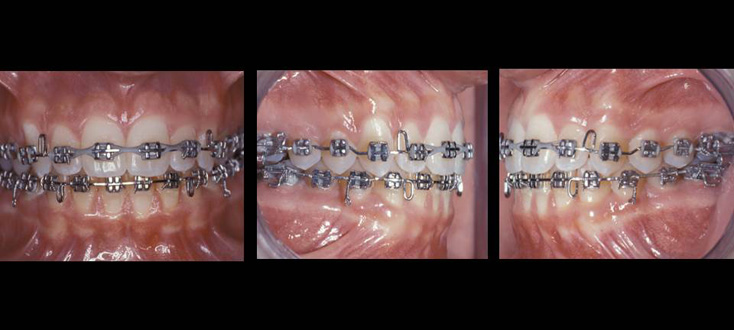 Tratamento: intercuspidação dentária