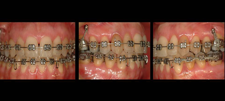 Tratamento: mini-implantes (temporários)
